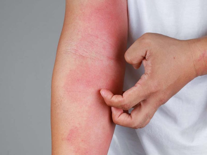 Más del 20% de las personas con psoriasis en Argentina presenta formas severas de la enfermedad. La importancia del diagnóstico temprano y el acceso al tratamiento