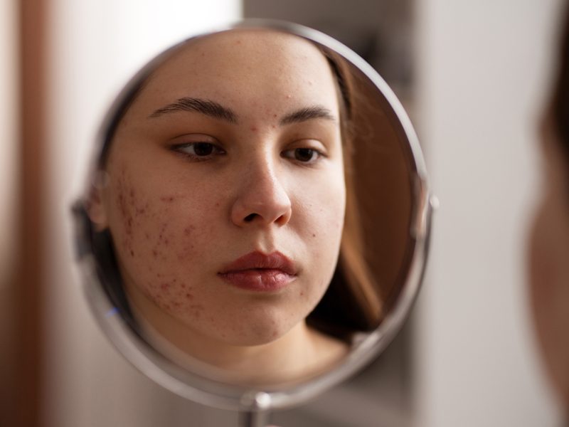 Brote de acné después del verano: causas y cómo prevenirlo