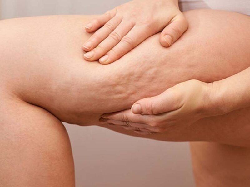 Tratamientos innovadores para la celulitis: un abordaje médico integral