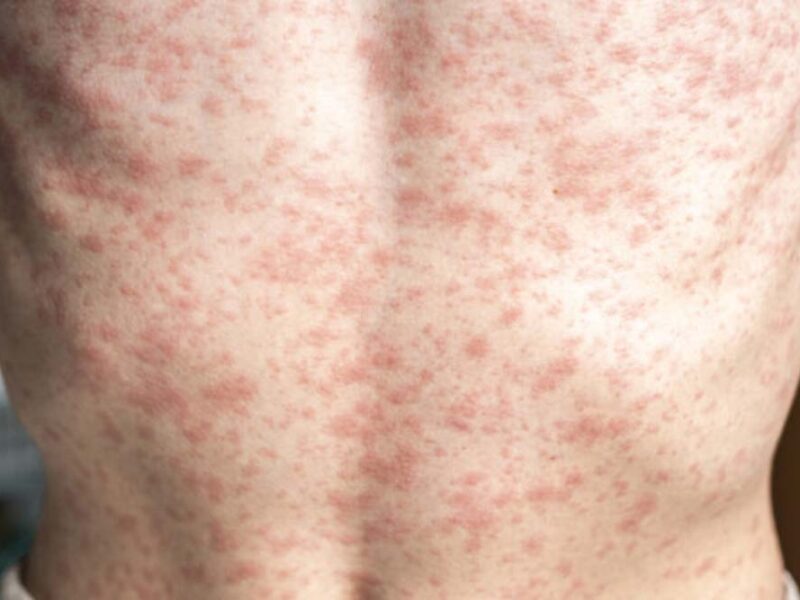Alarma por Sarampión en Chile: ¿Qué hacer y cómo prevenir contagios?