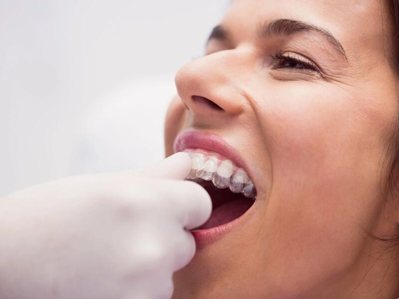 Ortodoncia Invisible