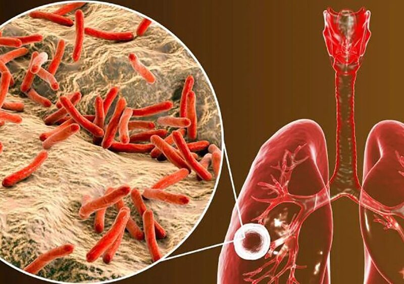 Tuberculosis: el diagnóstico temprano y el control de la infección latente, claves en el Día Mundial