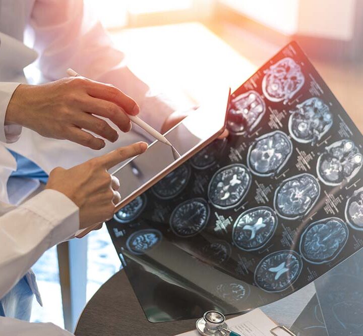 Llega a Argentina una terapia que es la primera innovación para gliomas en más de 20 años (1)