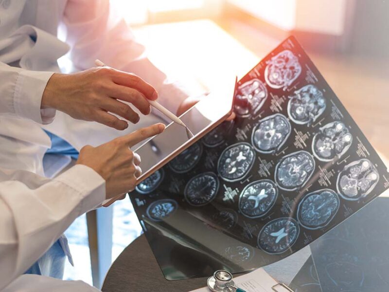 Llega a Argentina una terapia que es la primera innovación para gliomas en más de 20 años (1)