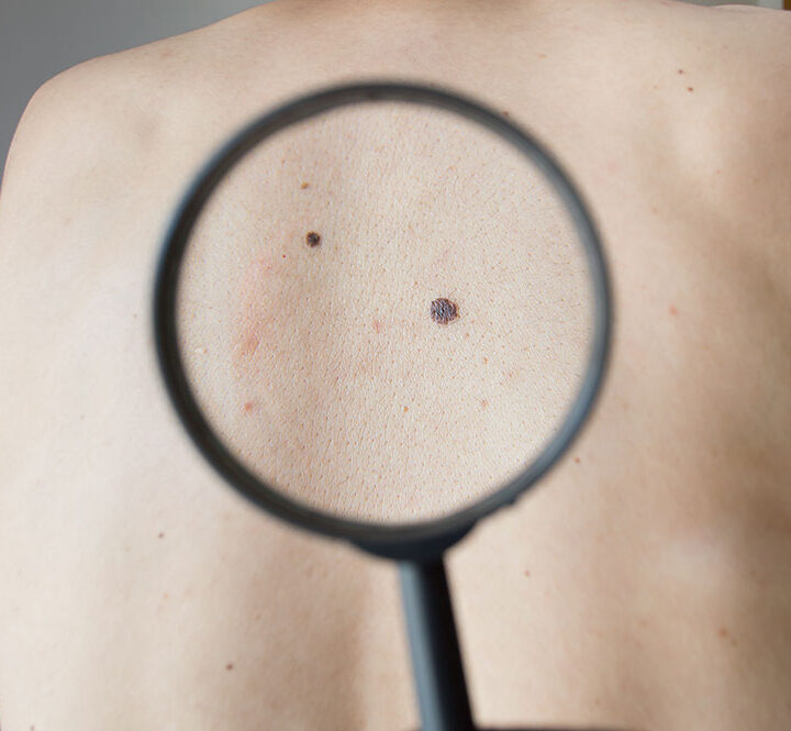 Día Mundial del Melanoma: los últimos avances en los tratamientos de un tipo de tumor que crece en la Argentina