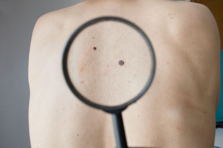 Día Mundial del Melanoma: los últimos avances en los tratamientos de un tipo de tumor que crece en la Argentina