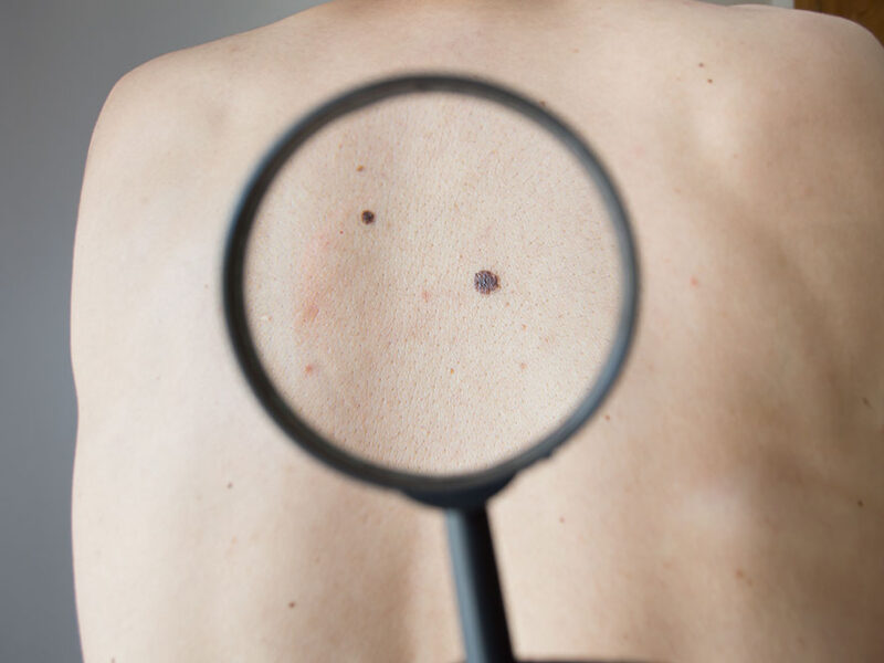Día Mundial del Melanoma: los últimos avances en los tratamientos de un tipo de tumor que crece en la Argentina