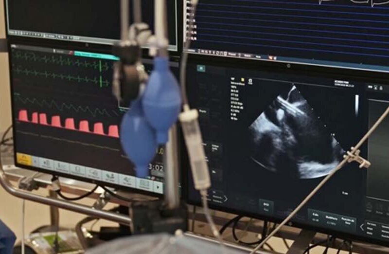 ICBA realiza el primer procedimiento con PulseSelect™ en Argentina y refuerza su liderazgo regional en innovación cardiovascular