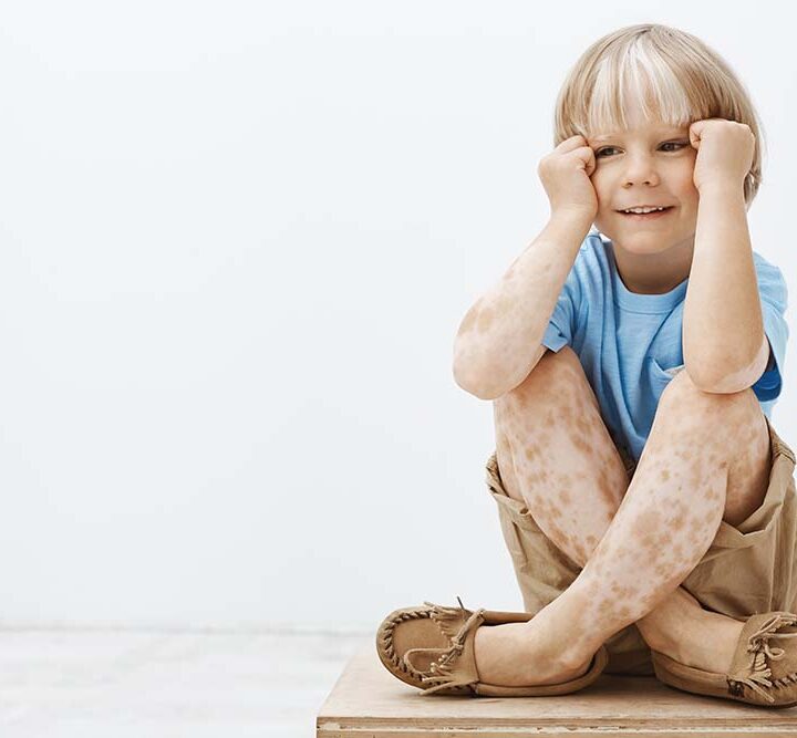Lo que casi nadie sabe sobre el vitiligo: los mitos que los especialistas buscan derribar