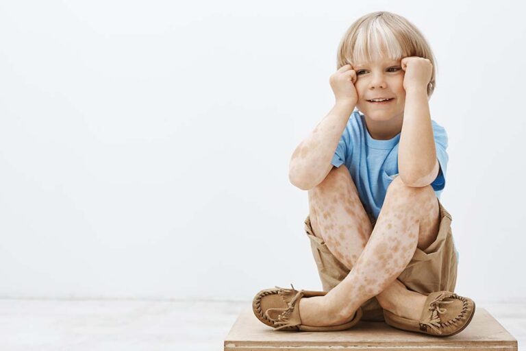 Lo que casi nadie sabe sobre el vitiligo: los mitos que los especialistas buscan derribar