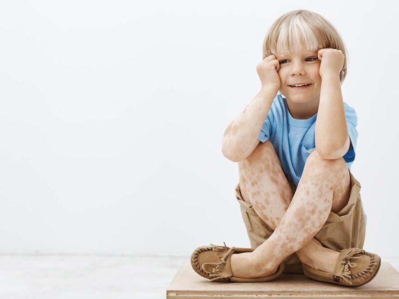 Lo que casi nadie sabe sobre el vitiligo: los mitos que los especialistas buscan derribar