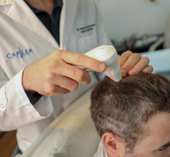 Alopecia: mitos sobre la caída del cabello que todavía muchos creen
