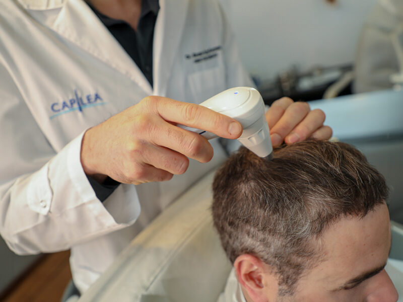 Alopecia: mitos sobre la caída del cabello que todavía muchos creen