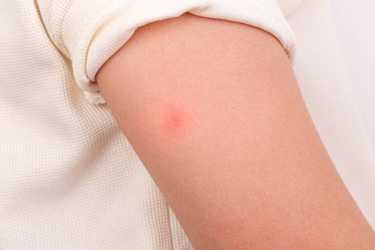 Alergias y picaduras de insectos: cómo reconocer a tiempo una emergencia médica