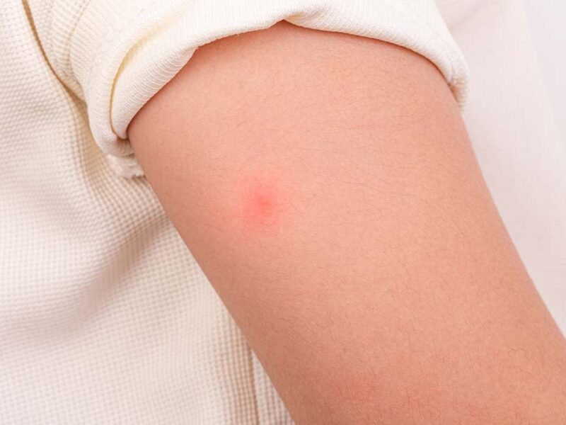 Alergias y picaduras de insectos: cómo reconocer a tiempo una emergencia médica